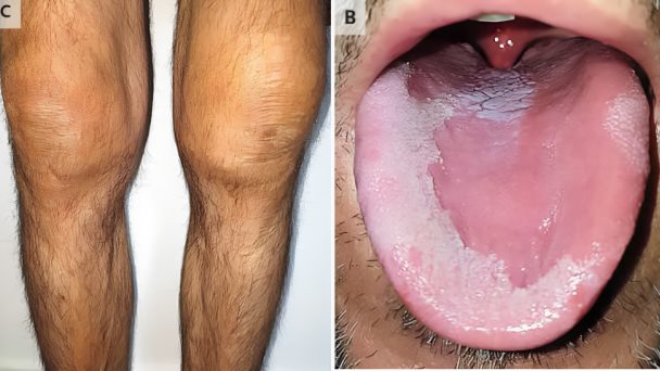 Secreción uretral culmina con diagnóstico de artritis reactiva, conjuntivitis, glositis y balanitis Secreción uretral culmina con diagnóstico de artritis reactiva, conjuntivitis, glositis y balanitis