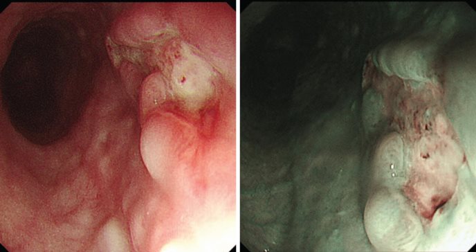 Detectan úlcera gastroesofágica causada por infección de VPH tipo 16 en hombre de 71 años