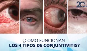 &iquest;Qu&eacute; es la conjuntivitis y cu&aacute;les son sus cuatro tipos? - #ExclusivoMSP