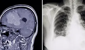 Mal de altura: signos y complicaciones como edema cerebral o pulmonar debido a entornos de gran altitud