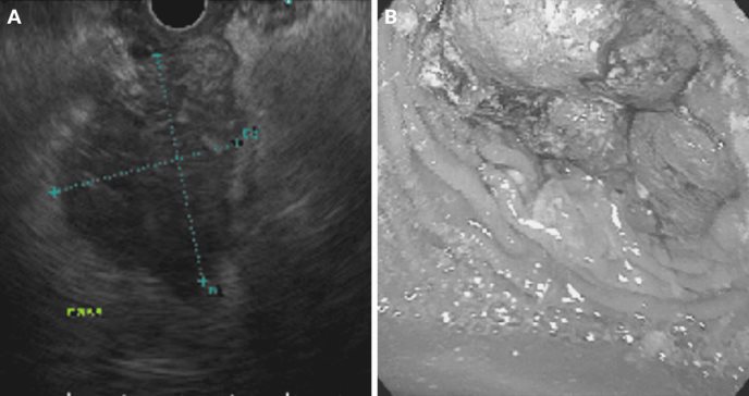 Cáncer de colon se presenta mediante cetoacidosis diabética por metástasis pancreática en etapa avanzada