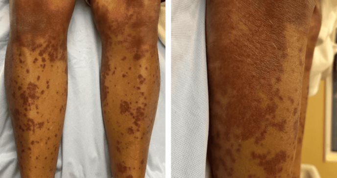 Paciente puertorriqueño desarrolla vasculitis leucocitoclástica tras tratamiento de antibiótico