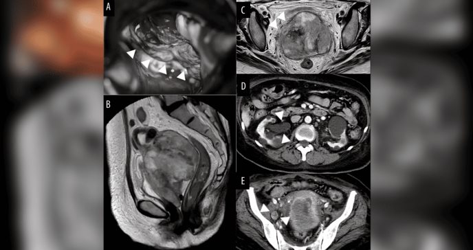 Mujer con diagnóstico de cáncer cervicouterino por masa maloliente sufre ceguera por metástasis ocular