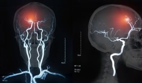 Cenar y desayunar temprano podrían disminuir el riesgo de enfermedades cardiovasculares, según estudio
