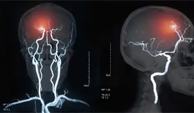 Cenar y desayunar temprano podr&iacute;an disminuir el riesgo de enfermedades cardiovasculares, seg&uacute;n estudio