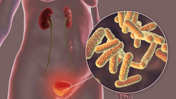 Cistitis recurrente no siempre es bacteriana y puede ser por vejiga hiperactiva o síndrome de dolor crónico Cistitis recurrente no siempre es bacteriana y puede ser por vejiga hiperactiva o síndrome de dolor crónico