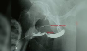 Paciente con dolor y ardor en zona genital termina con desgarro uretral de tipo V tras sufrir caída