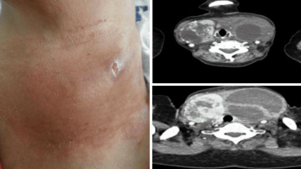 Describen raro caso de enfermedad tiroidea supurativa con nódulo necrotizado por infección de salmonella