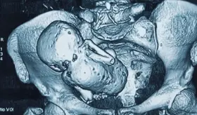 Litopediones, extraño fenómeno en el que los fetos se petrifican dentro del cuerpo