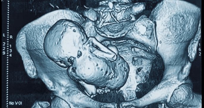 Litopediones, extraño fenómeno en el que los fetos se petrifican dentro del cuerpo