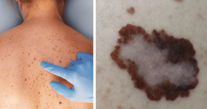 ¿Por qué el melanoma es más frecuente en mujeres, pero con una tasa de mortalidad mayor en hombres?