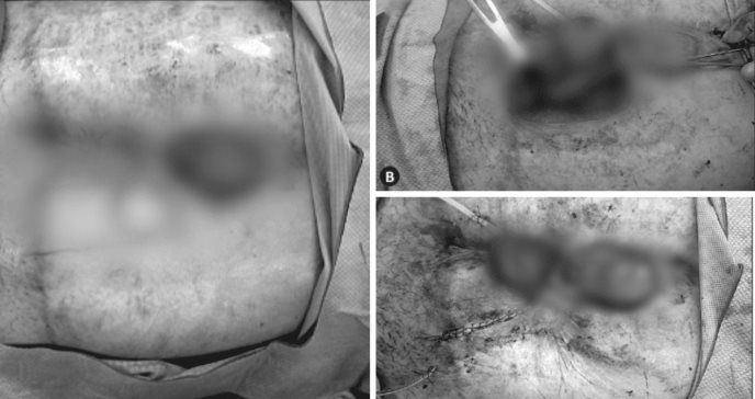 Exitoso cierre de fístula con colgajo miocutáneo en mujer con mutación de factor V de Leiden