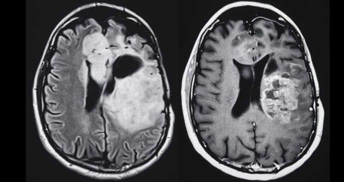 Análisis de sangre podría anticipar señales tempranas de la enfermedad de Alzheimer en el cerebro