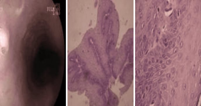 Paciente es diagnosticado con rara papilomatosis esofágica por VPH tras presentar regurgitaciones ácidas