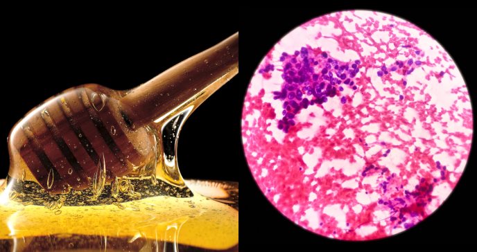 Miel de castaño con jalea real y propóleo muestra potencial efecto contra células hepáticas tumorales