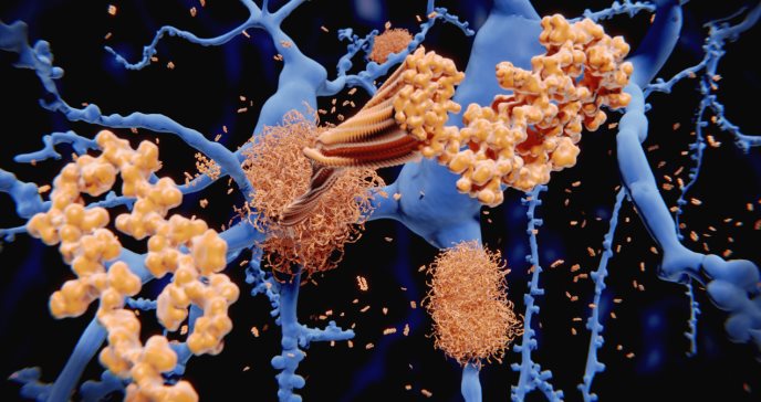 Identifican 5 subtipos distintos de Alzhéimer gracias a análisis de proteínas en líquido cefalorraquídeo