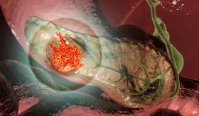 Científicos crean modelo innovador para determinar el riesgo de cáncer de páncreas