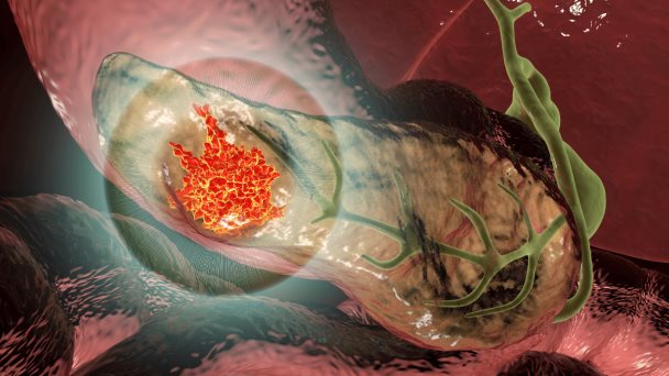 Científicos crean modelo innovador para determinar el riesgo de cáncer de páncreas Científicos crean modelo innovador para determinar el riesgo de cáncer de páncreas