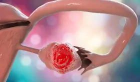 Desarrollan nueva prueba para detectar cáncer de ovario en etapas tempranas con precisión del 93%