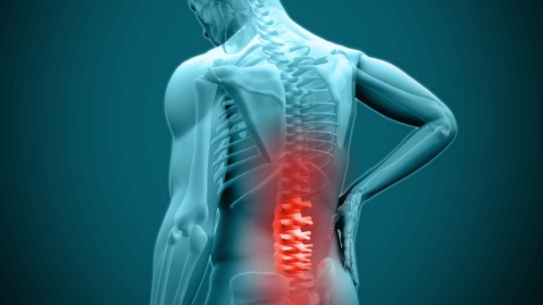Lumbalgia crónica requiere tratamiento personalizado pues neuroestimulación y opiáceos no son efectivos