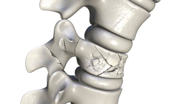 Cómo reconocer las fracturas por estrés debido a tensión repetitiva en una región ósea específica Cómo reconocer las fracturas por estrés debido a tensión repetitiva en una región ósea específica
