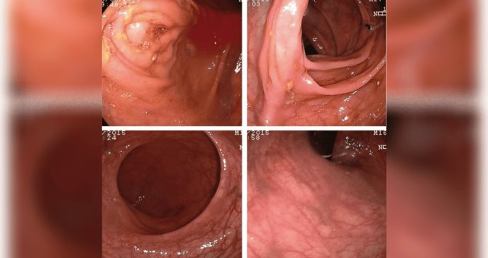 Combinación de compuestos a base de plantas logran remisión de Colitis Ulcerosa en ensayo clínico