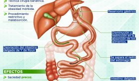 Bypass gástrico | Infografía