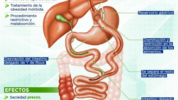 Bypass gástrico | Infografía Bypass gástrico | Infografía