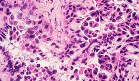 Descubren que células cancerosas de pulmón secuestran el sistema inmunitario para nutrir su crecimiento