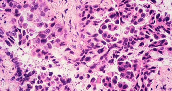 Descubren que células cancerosas de pulmón secuestran el sistema inmunitario para nutrir su crecimiento