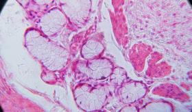 Investigadores crean mapa molecular detallado de la inflamación crónica del esófago