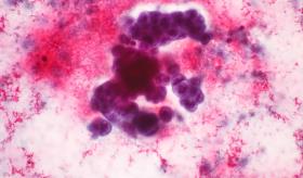 Ácidos grasos reconfiguran metabolismo para satisfacer elevada demanda energética del cáncer de estómago