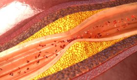 Preocupa aumento de hipertrigliceridemia en jóvenes y su conexión con el alto riesgo de diabetes tipo 2