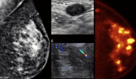 Mamografía por emisión de positrones emerge como revolucionaria técnica para detectar cáncer de mama