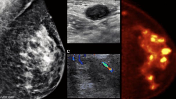 Mamografía por emisión de positrones emerge como revolucionaria técnica para detectar cáncer de mama Mamografía por emisión de positrones emerge como revolucionaria técnica para detectar cáncer de mama