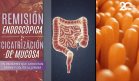 Remisión endoscópica y cicatrización de mucosa en pacientes con Crohn y Colitis ulcerosa - #EspecialMSP