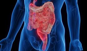 Nuevos enfoques terapéuticos para pacientes con síndrome de intestino irritable