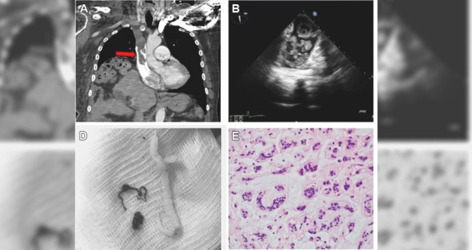 Realizan bypass cardiopulmonar para extraer tumor intracardíaco con cánula venosa en paciente