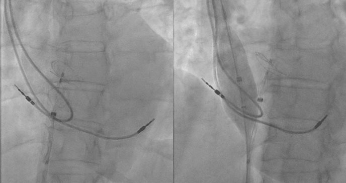 Electrodo de marcapasos queda atrapado entre órgano y dispositivo durante cierre de foramen oval