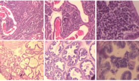 Descubren subproducto del aceite de sándalo, lawsona, que previene desarrollo de cáncer de próstata
