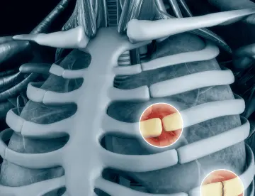 ¿Dolor punzante en el pecho que empeora con la respiración? Costocondritis es la inflamación responsable