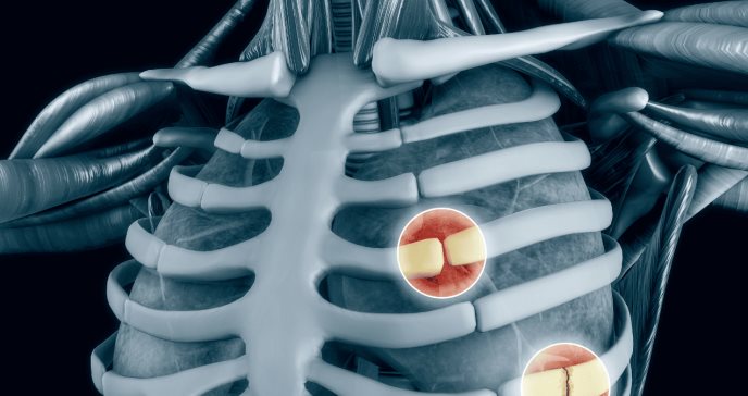 ¿Dolor punzante en el pecho que empeora con la respiración? Costocondritis es la inflamación responsable