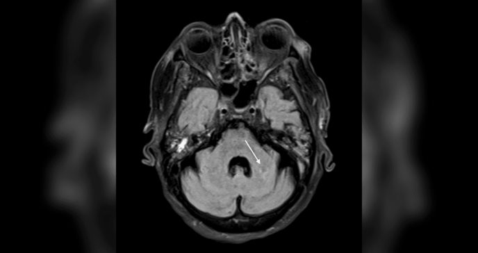 Síndrome antifosfolípido catastrófico ocasiona trombosis multiorgánica aguda en paciente con lupus