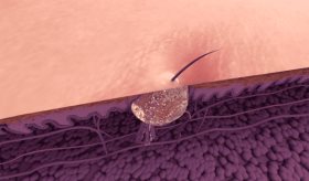 Descifrando el misterio de la "Zona T": ¿Por qué hay un área del rostro con más producción de sebo?