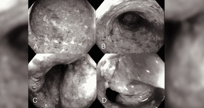 Hipo intratable se manifiesta como exacerbación de colitis ulcerosa por infección con salmonella