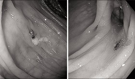 Hallan abeja viva en el colon de paciente con antecedentes de cáncer esofágico durante colonoscopia