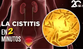 Qué es la cistitis en 2 minutos -#EspecialMSP