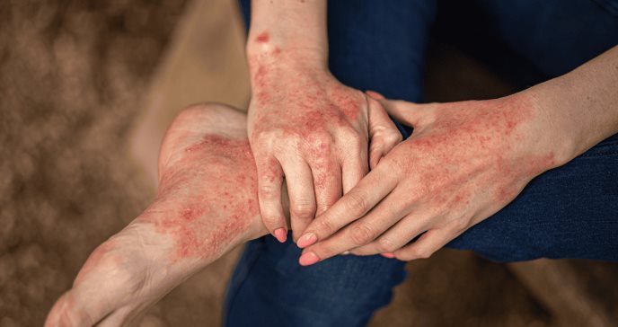 Bacterioterapia o baños en lejía diluida: ¿Cómo preservar el microbioma cutáneo con dermatitis atópica?