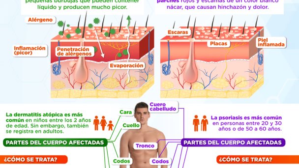 Diferencias entre la dermatitis atópica y psoriasis | Infografía