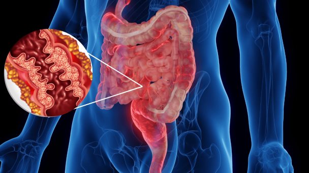 Tratamiento avanzado puede reducir cirugías abdominales para tratar Enfermedad de Crohn Tratamiento avanzado puede reducir cirugías abdominales para tratar Enfermedad de Crohn